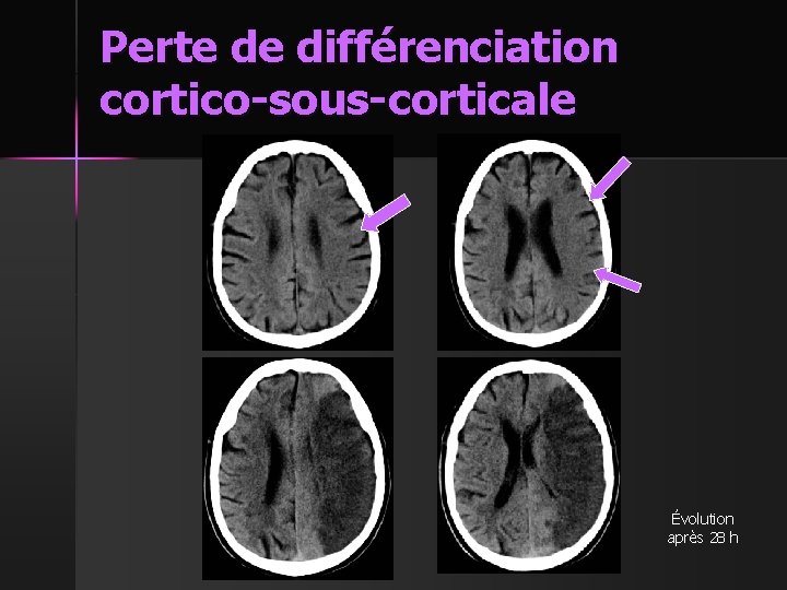 Perte de différenciation cortico-sous-corticale Évolution après 28 h 