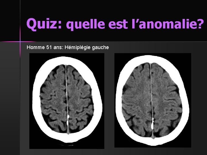 Quiz: quelle est l’anomalie? Homme 51 ans: Hémiplégie gauche 