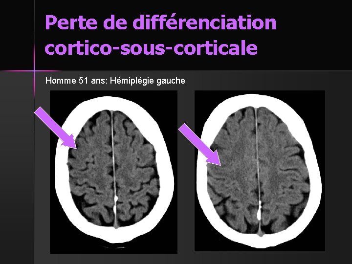 Perte de différenciation cortico-sous-corticale Homme 51 ans: Hémiplégie gauche 