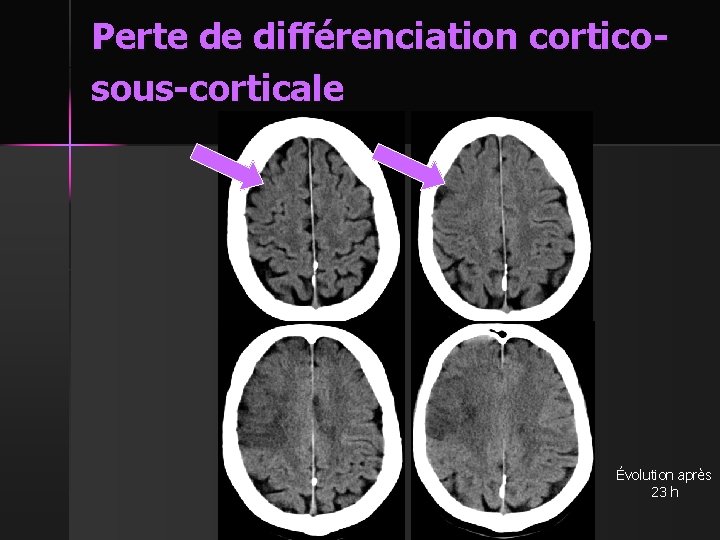 Perte de différenciation corticosous-corticale Évolution après 23 h 