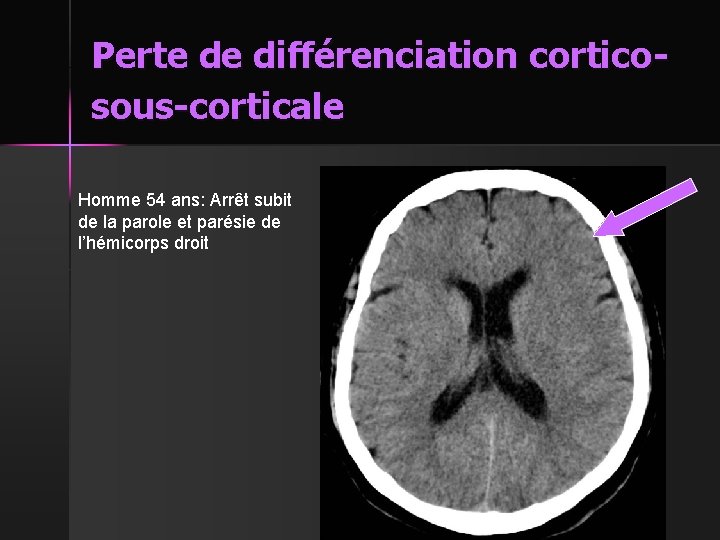 Perte de différenciation corticosous-corticale Homme 54 ans: Arrêt subit de la parole et parésie