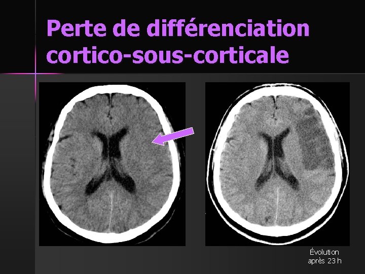 Perte de différenciation cortico-sous-corticale Évolution après 23 h 