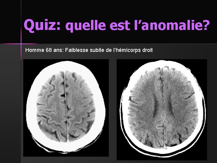 Quiz: quelle est l’anomalie? Homme 68 ans: Faiblesse subite de l’hémicorps droit 