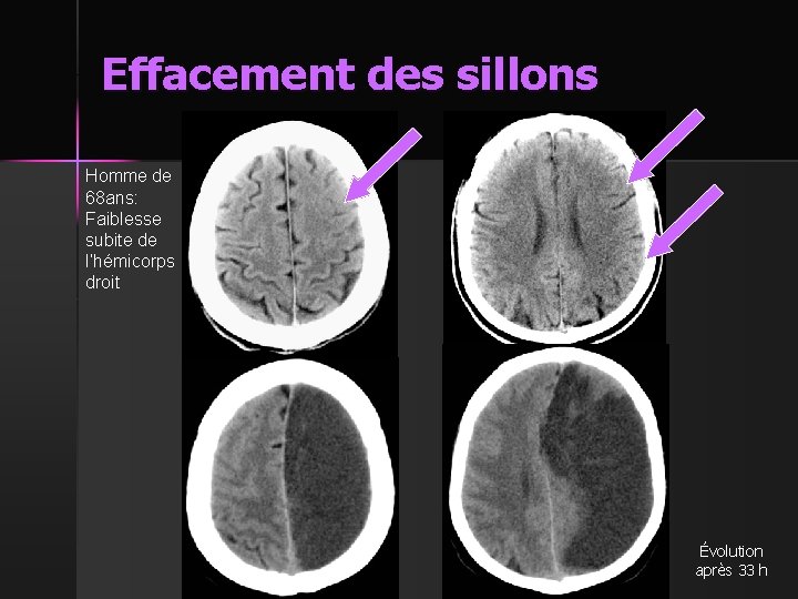 Effacement des sillons Homme de 68 ans: Faiblesse subite de l’hémicorps droit Évolution après