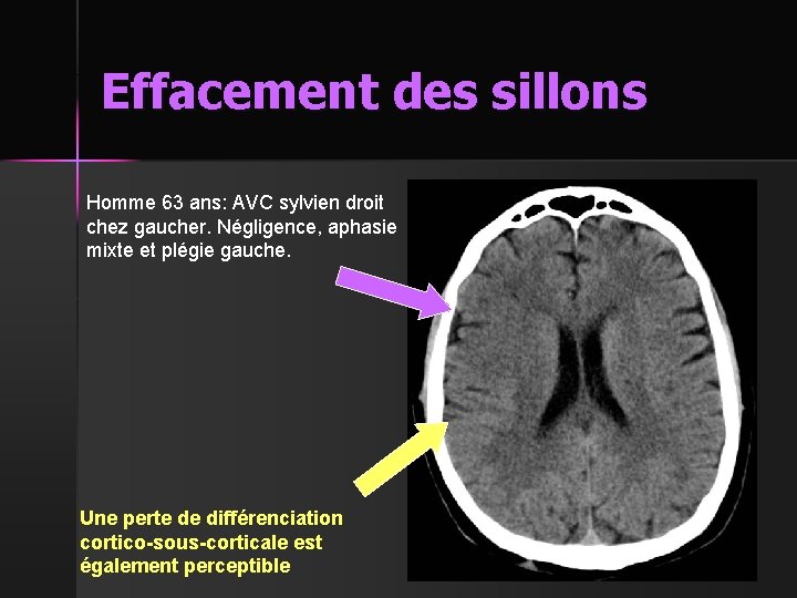 Effacement des sillons Homme 63 ans: AVC sylvien droit chez gaucher. Négligence, aphasie mixte