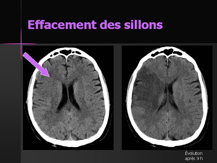 Effacement des sillons Évolution après 9 h 