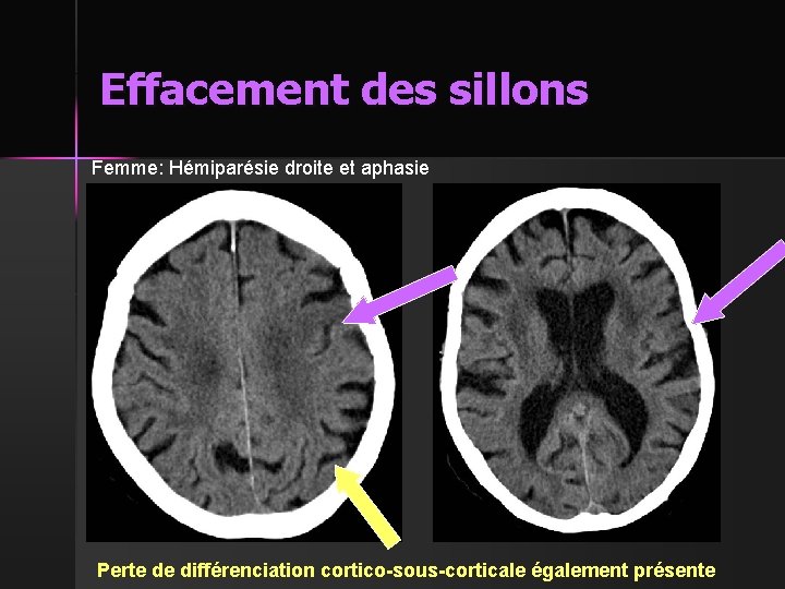 Effacement des sillons Femme: Hémiparésie droite et aphasie Perte de différenciation cortico-sous-corticale également présente