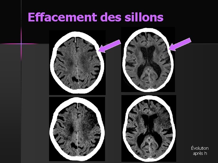 Effacement des sillons Évolution après h 