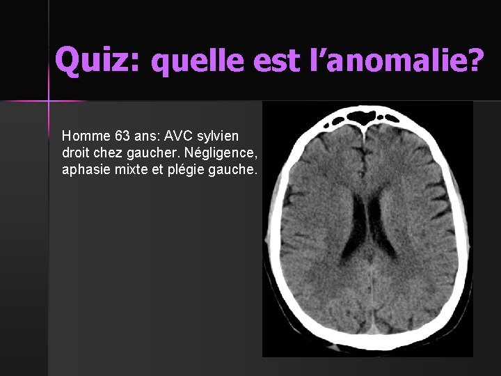 Quiz: quelle est l’anomalie? Homme 63 ans: AVC sylvien droit chez gaucher. Négligence, aphasie