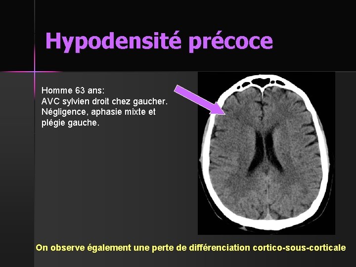 Hypodensité précoce Homme 63 ans: AVC sylvien droit chez gaucher. Négligence, aphasie mixte et