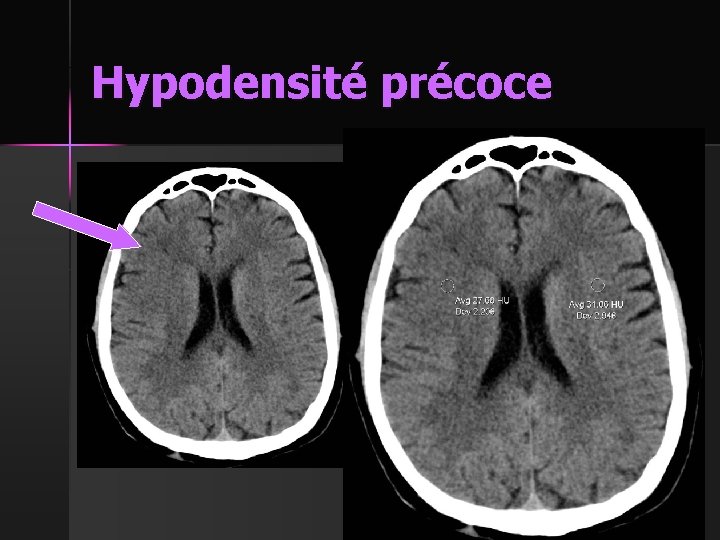 Hypodensité précoce 