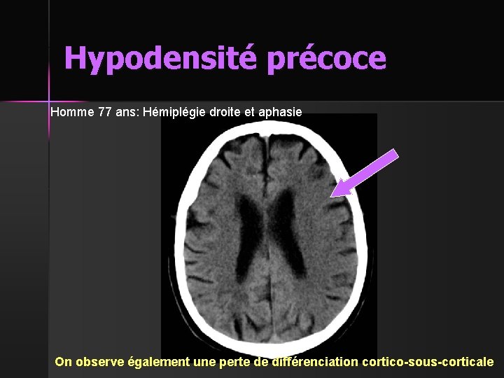 Hypodensité précoce Homme 77 ans: Hémiplégie droite et aphasie On observe également une perte