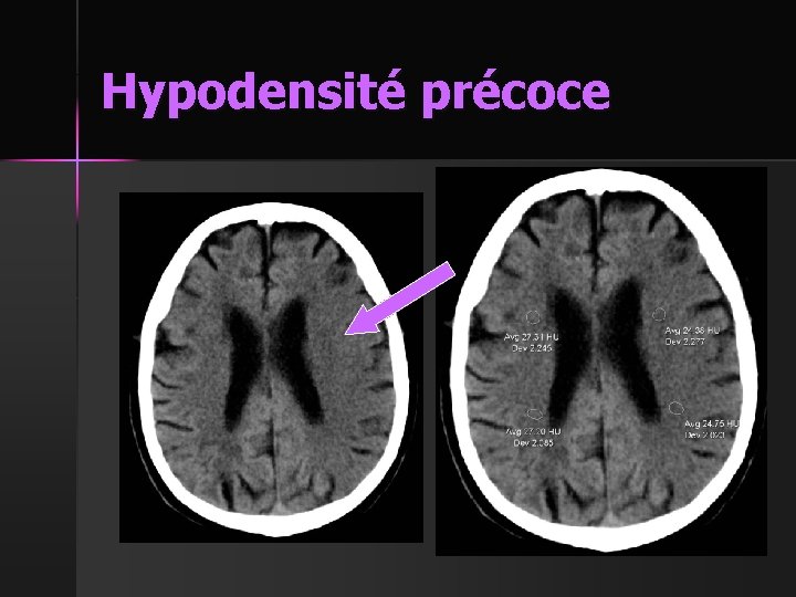 Hypodensité précoce 