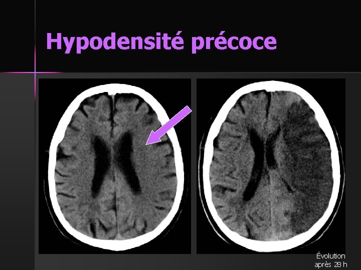 Hypodensité précoce Évolution après 28 h 