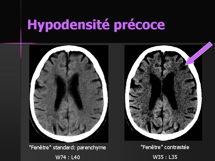 Hypodensité précoce "Fenêtre" standard: parenchyme "Fenêtre" contrastée W 74 : L 40 W 35