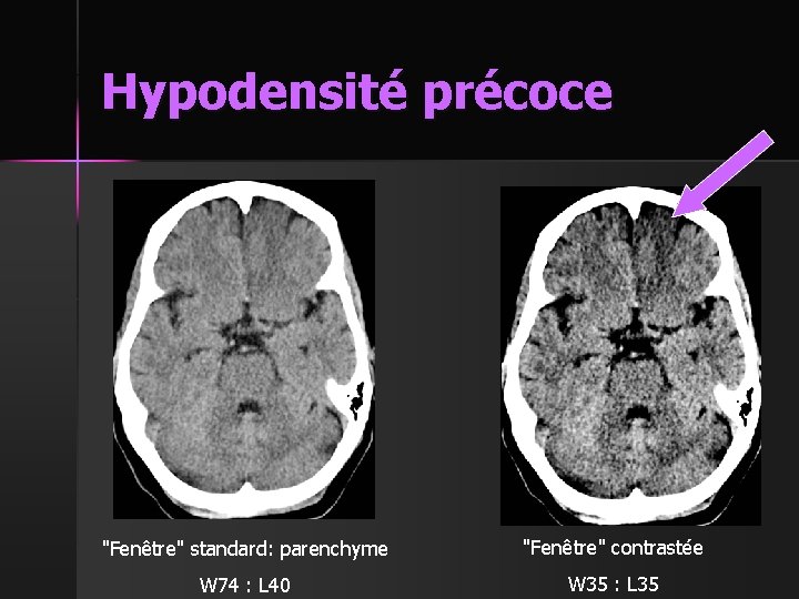 Hypodensité précoce "Fenêtre" standard: parenchyme "Fenêtre" contrastée W 74 : L 40 W 35