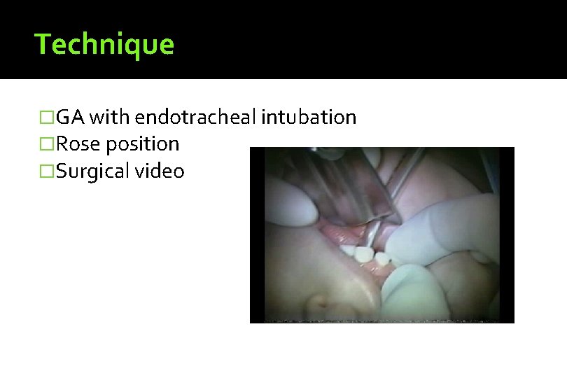 Technique �GA with endotracheal intubation �Rose position �Surgical video 