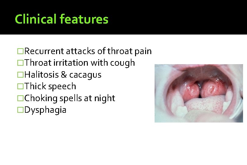 Clinical features �Recurrent attacks of throat pain �Throat irritation with cough �Halitosis & cacagus