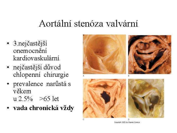 Aortální stenóza valvární • 3. nejčastější onemocnění kardiovaskulární • nejčastější důvod chlopenní chirurgie •