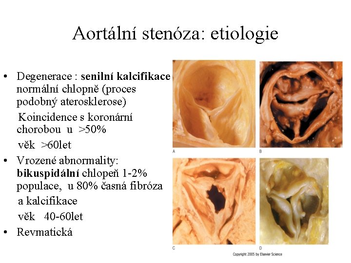 Aortální stenóza: etiologie • Degenerace : senilní kalcifikace normální chlopně (proces podobný aterosklerose) Koincidence