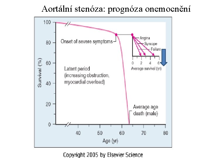 Aortální stenóza: prognóza onemocnění Prognosis since symp 