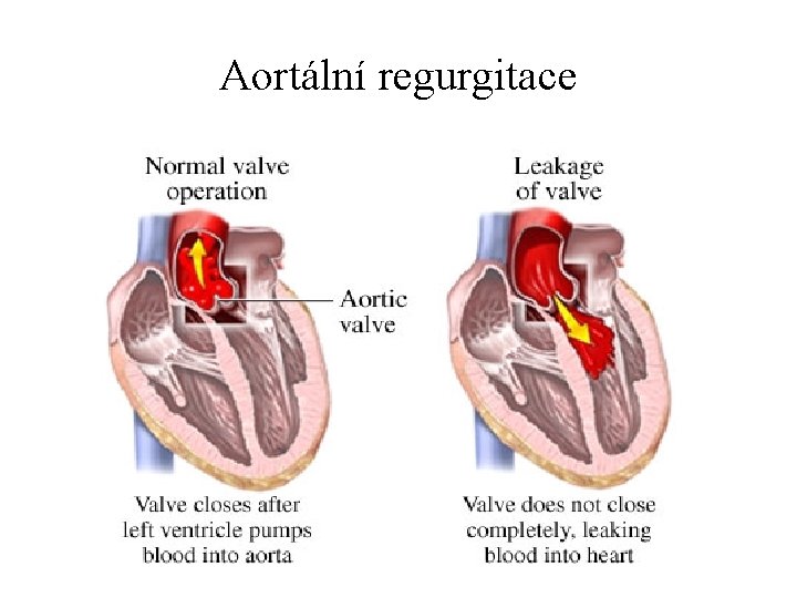 Aortální regurgitace 