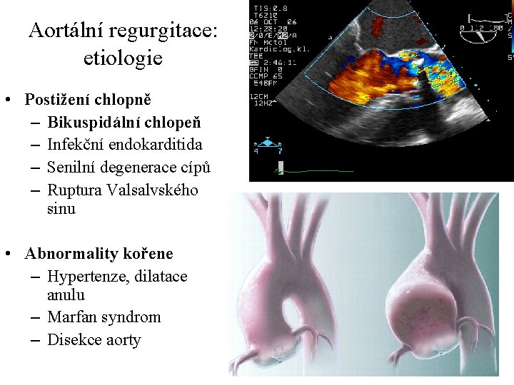 Aortální regurgitace: etiologie • Postižení chlopně – Bikuspidální chlopeň – Infekční endokarditida – Senilní