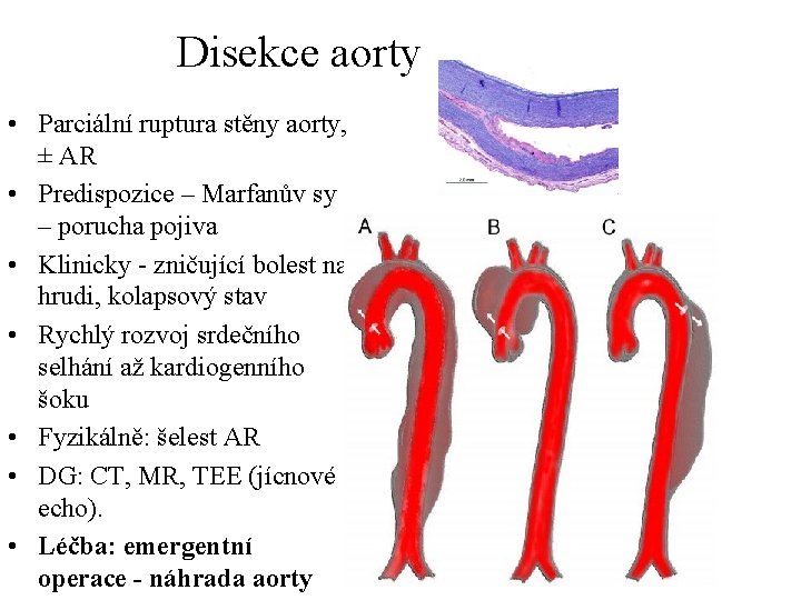 Disekce aorty • Parciální ruptura stěny aorty, ± AR • Predispozice – Marfanův sy
