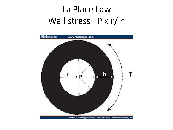 La Place Law Wall stress= P x r/ h 