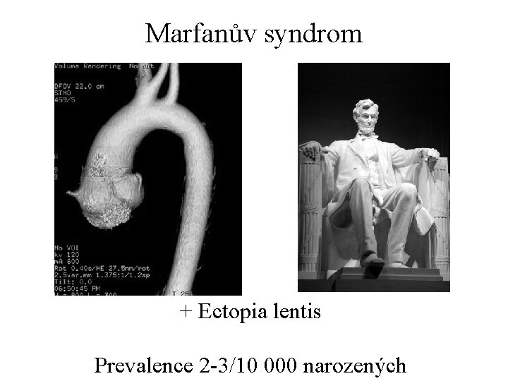 Marfanův syndrom + Ectopia lentis Prevalence 2 -3/10 000 narozených 