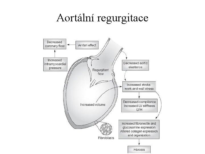 Aortální regurgitace 
