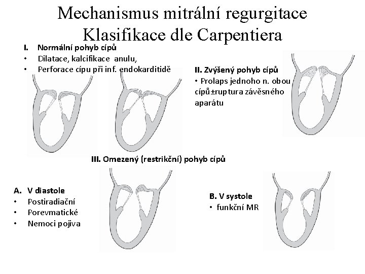 Mechanismus mitrální regurgitace Klasifikace dle Carpentiera I. Normální pohyb cípů • Dilatace, kalcifikace anulu,