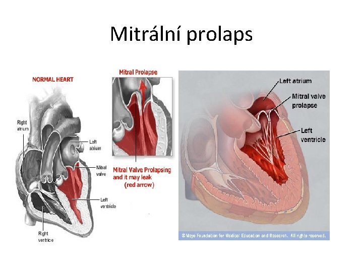 Mitrální prolaps 