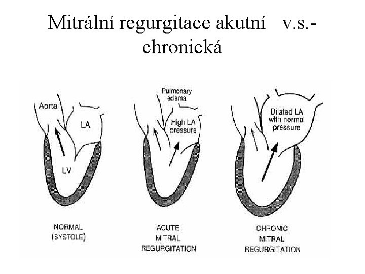 Mitrální regurgitace akutní v. s. - chronická 