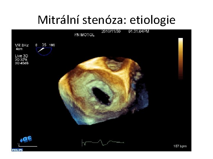 Mitrální stenóza: etiologie 