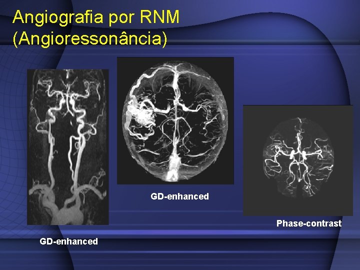 Angiografia por RNM (Angioressonância) GD-enhanced Phase-contrast GD-enhanced 