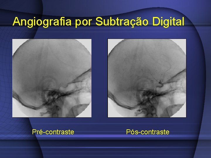 Angiografia por Subtração Digital Pré-contraste Pós-contraste 