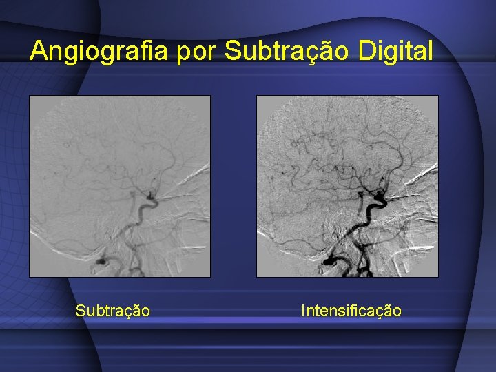 Angiografia por Subtração Digital Subtração Intensificação 