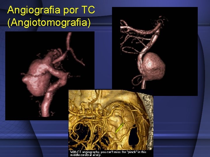 Angiografia por TC (Angiotomografia) 