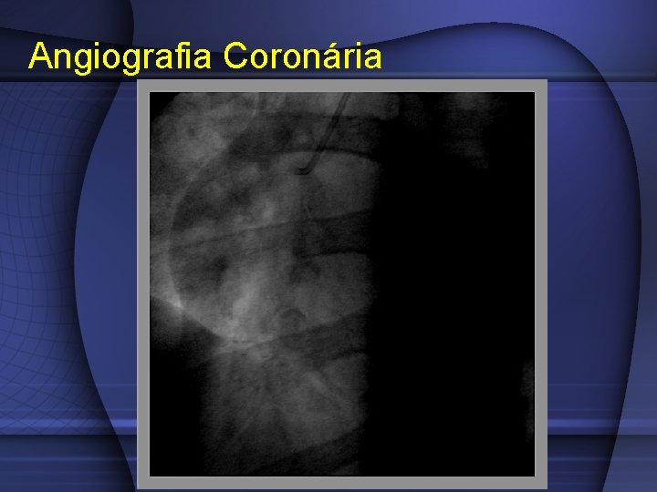 Angiografia Coronária 