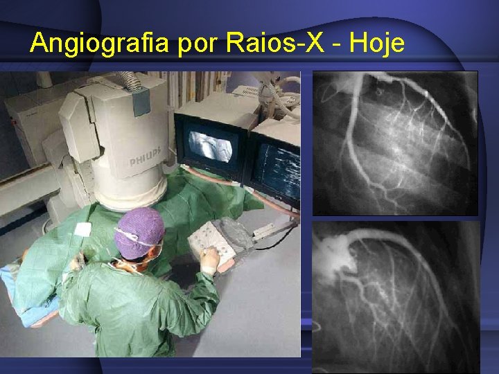 Angiografia por Raios-X - Hoje 