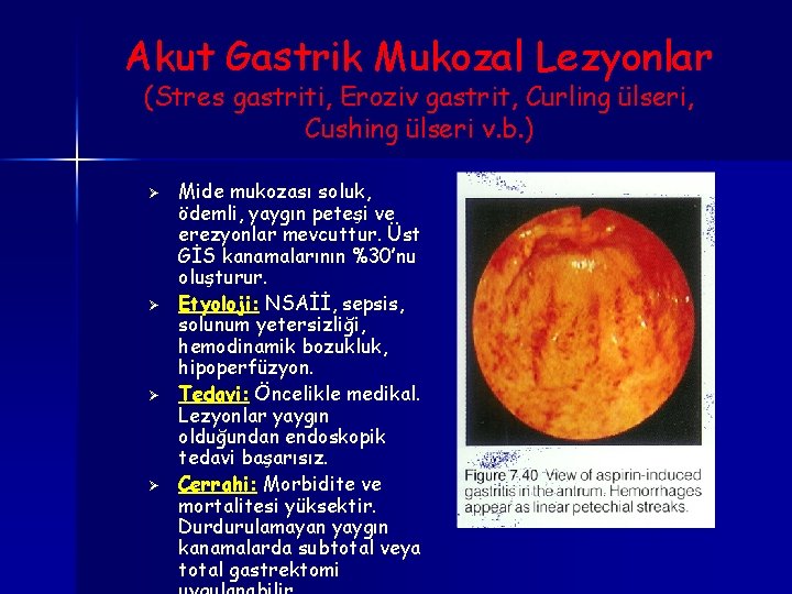 Akut Gastrik Mukozal Lezyonlar (Stres gastriti, Eroziv gastrit, Curling ülseri, Cushing ülseri v. b.