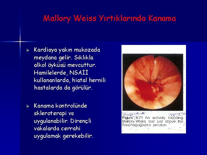 Mallory Weiss Yırtıklarında Kanama Ø Ø Kardiaya yakın mukozada meydana gelir. Sıklıkla alkol öyküsü