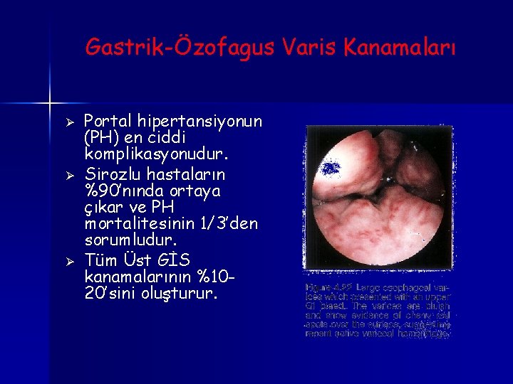 Gastrik-Özofagus Varis Kanamaları Ø Ø Ø Portal hipertansiyonun (PH) en ciddi komplikasyonudur. Sirozlu hastaların