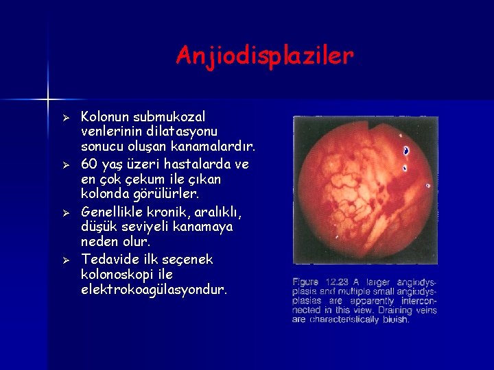 Anjiodisplaziler Ø Ø Kolonun submukozal venlerinin dilatasyonu sonucu oluşan kanamalardır. 60 yaş üzeri hastalarda