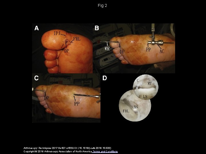 Fig 2 Arthroscopy Techniques 2017 6 e 427 -e 433 DOI: (10. 1016/j. eats.