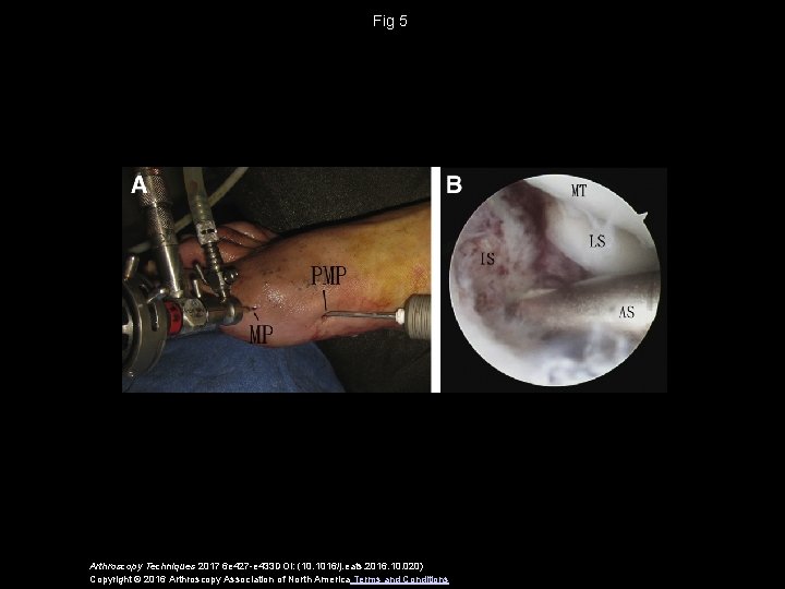 Fig 5 Arthroscopy Techniques 2017 6 e 427 -e 433 DOI: (10. 1016/j. eats.