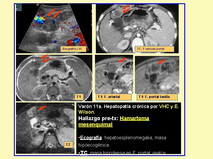 Ecografía LHI T 1 TC: F venosa portal T 1: F. arterial T 1: Ecografía LHI T 1 TC: F venosa portal T 1: F. arterial T 1: