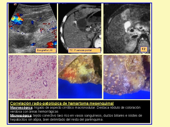 Ecografía LHI TC: F venosa portal T 2 Correlación radio-patológica de hamartoma mesenquimal Macroscópica: Ecografía LHI TC: F venosa portal T 2 Correlación radio-patológica de hamartoma mesenquimal Macroscópica: