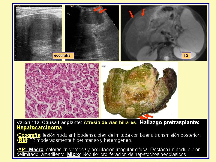 ecografía T 2 Varón 11 a. Causa trasplante: Atresia de vías biliares. Hallazgo pretrasplante: ecografía T 2 Varón 11 a. Causa trasplante: Atresia de vías biliares. Hallazgo pretrasplante: